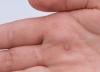 Photo for Acute Bacterial Skin and Skin Structure Infections (ABSSSI) Market Projected to Grow Steadily During 2018-2026