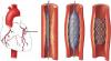 Photo for Vascular Stent Market Report 2018-2025 Product Scope, Key Players, Trends, Growth Rate & Industry Outlook