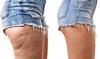 Photo for Cellulite Treatment Market Development Industry 2019 Featuring