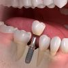 Photo for Global Dental Implants And Prosthetics Market Growth Opportunities, Industry Analysis, Geographic Segmentation and Competitive Landscape Report to 2024