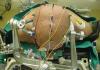 Photo for Intraoperative Neuromonitoring Market To Be At Forefront By 2026