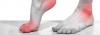 Photo for Diabetic Neuropathy is the damage caused to the nerve due to diabetes which often leads to pain and numbness in feet or lower legs.