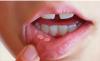 Photo for Mouth Ulcer Treatment Market - Global Industry Insights, Trends, Outlook, and Opportunity Analysis, 2018–2026