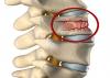 Photo for Vertebral Compression Fracture Devices Market Foreseen To Grow Exponentially Over 2026