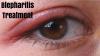 Photo for Blepharitis Treatment Market Share To 2026 Anticipeted By Global Key Players