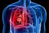 Photo for Lung Cancer Therapeutics Market Moving Toward 2026 With New Procedures