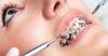 Photo for Dental Braces Market 2019-2026 With Strategic Trends Growth, Revenue, Demand & Future Potential Of Industry