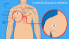 Photo for Central Venous Catheter Market to Record an Impressive Growth Rate by 2026