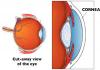 Photo for Cornea Specialist