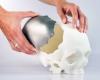 Photo for 3D Printed Medical Implants Market - Trends, Opportunity And Analysis 2026