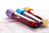 Photo for Autoimmune Disease Diagnostics Market Growing at Steady CAGR to 2026