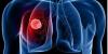 Photo for Cancer/Tumor Profiling Market - Industry Insights, Trends, Opportunity And Analysis 2026