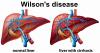 Photo for Global Wilson’s Disease Treatment Market Increased International Trade Opening New Opportunities