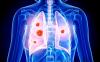 Photo for Non-Small Cell Lung Cancer Market – Global Industry Insights, Trends, Outlook, and Opportunity Analysis, 2018-2026