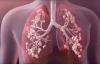 Photo for Cystic Fibrosis Market Prognosticated For A Ravishing Growth By 2026