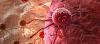 Photo for Angiosarcomas Treatment Market Boosting The Growth Worldwide: 2026 Market Key Dynamics