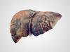 Photo for Liver Disease Treatment Market