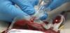 Photo for Latest Report of Hemophilia Treatment Market with Current Trends, Drivers, Strategies