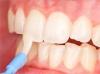 Photo for Global Fluoride Varnish Market 2019 | Manufacturers, Regions, Type And Application, Forecast To 2024