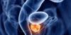 Photo for Prostate Cancer Therapeutics Market Trends And Growth