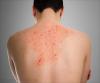 Photo for Fabry Disease Treatment Market - Size, Share, Outlook, and Opportunity Analysis,