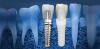 Photo for Global Titanium Dental Implants Market Manufacturers Sales Analysis Report 2019-2024