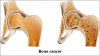 Photo for Bone Cancer Treatment Market Accrues Phenomenally by 2026 with a Staggering CAGR