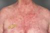 Photo for Pemphigus Vulgaris Treatment Market: Healthcare and Treatment Methodology 2018 To 2026