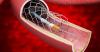 Photo for Non-vascular Stents Market  Growth And Future Outlook By 2025