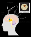 Photo for Neuroendoscopy Devices Market Size, Share, Growth and Forecast Report, 2018 to 2025