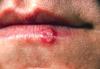 Photo for Herpes Simplex Virus (HSV) Vaccines Market Trends Estimates High Demand by 2026