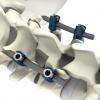 Photo for Osteosynthesis Devices Market Report From 2018 To 2025 Analysis By Top Company Profiles - DePuy Synthes, Inc. (J & J Company), Globus Medical Inc., GS Medical, LLC