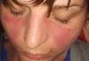 Photo for Systemic Lupus Erythematosus Treatment Market Latest Trends and Developments