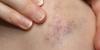 Photo for Porphyria Treatment Market Growth ,Opportunities, Revenue and sales, Trends and Developments Opportunity Analysis