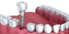 Photo for Dental Implants Market to Partake Significant Development By 2026