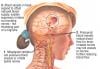 Photo for MIGRAINE HEADACHE TREATMENT