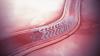 Photo for Bioabsorbable Stents Market Size, Trends & Industry Research Report 2018-2025