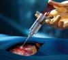 Photo for Tissue Sealants Market Report | Industry Size, Share and Forecast To, 2025