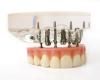 Photo for Dental Implants and Prosthetics Market 2018 : Industry Growth, Trends and Research Report, To 2025