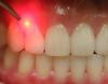 Photo for Dental Lasers Market Study By Product, Application & Top Key Players - Amd Lasers, Cao Group, Inc., Biolase, Inc., Fotona D.D., Danaher Corporation- Kavo Dental GmbH