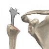 Photo for Global Humeral Head Joint Market Trend, Marketing Channels, Major Industry Participants, Strategies  and Forecast To 2024