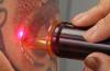 Photo for Global Tattoo Removal Devices Market Size, Share, Growth, Trend Analysis and Industry Statistics, 2019 to 2026