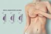 Photo for Breast Implant in Delhi | Breast Enlargement Surgery