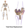 Photo for Knee Implant Market Size, Share, Growth, Trends and Forecast Report, 2024