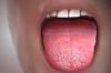 Photo for Xerostomia (Dry Mouth) Therapeutics Market Size, Share, Growth, Trends and Industry Analysis Report, 2018 to 2025