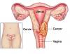 Photo for Cervical Cancer Diagnostic Market Size, Share, Growth, Trends and Forecast Report