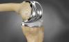 Photo for Artificial Joints Market Expansion to be Persistent During 2026