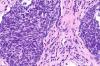 Photo for Non-small Cell Lung Cancer Therapeutics Market Size, Share, Growth, Trends and Forecast Report, 2018 to 2025