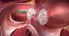 Photo for Global Heart Defect Closure Devices Market Manufacturers Sales Analysis Report 2019-2024