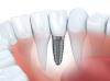 Photo for Dental Bone Graft Substitutes Market Study By Type, Product & Top Key Players - Biohorizons Iph, Inc., Dentium, Dentsply Sirona International, Geistlich Pharma AG, Institut Straumann AG